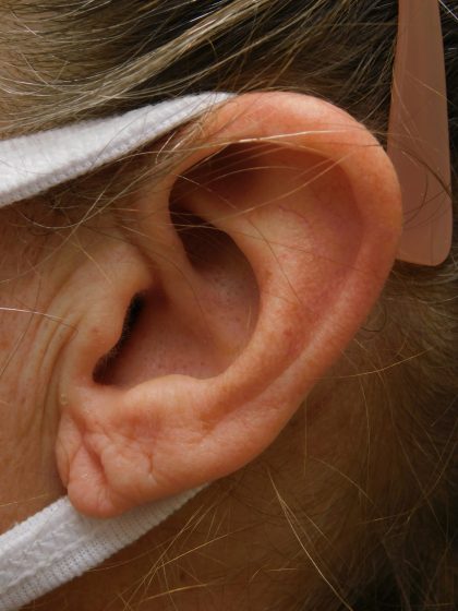 Earlobe Repair Before & After Patient #364