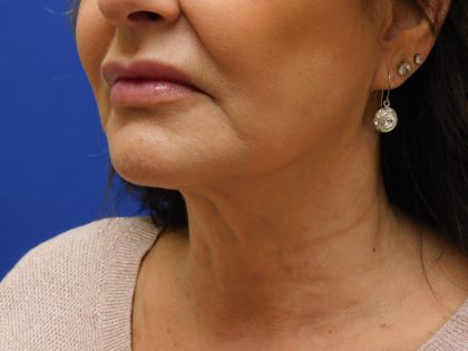 Face/Neck Lift Before & After Patient #492