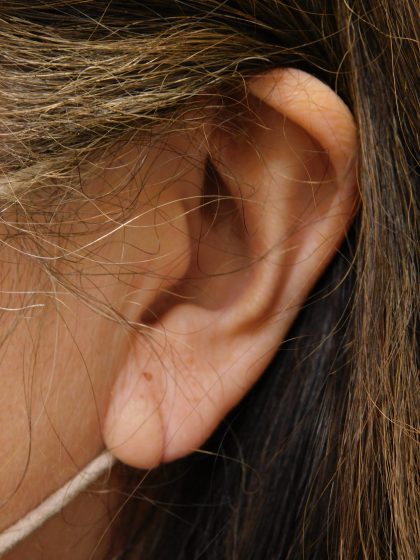 Earlobe Repair Before & After Patient #373