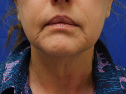 Face/Neck Lift Before & After Patient #513