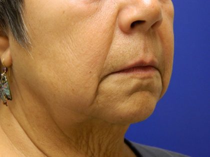 Face/Neck Lift Before & After Patient #558