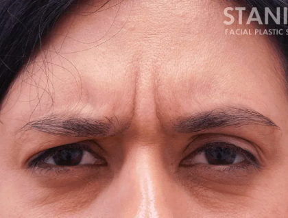 Botox Dysport Before & After Patient #151