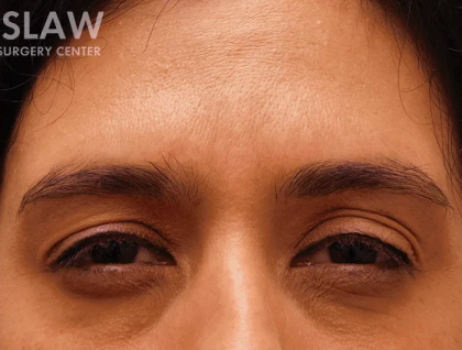 Botox Dysport Before & After Patient #151