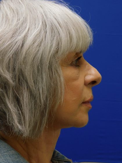 Face/Neck Lift Before & After Patient #524
