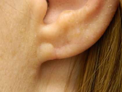 Earlobe Repair Before & After Patient #398