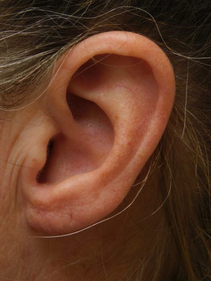 Earlobe Repair Before & After Patient #364