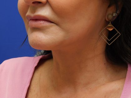 Face/Neck Lift Before & After Patient #492