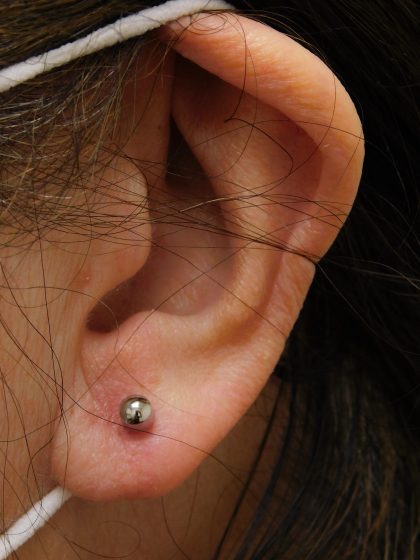 Earlobe Repair Before & After Patient #373