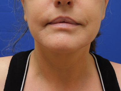 Face/Neck Lift Before & After Patient #513