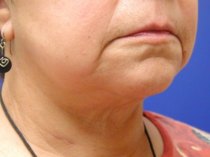 Face/Neck Lift Before & After Patient #558
