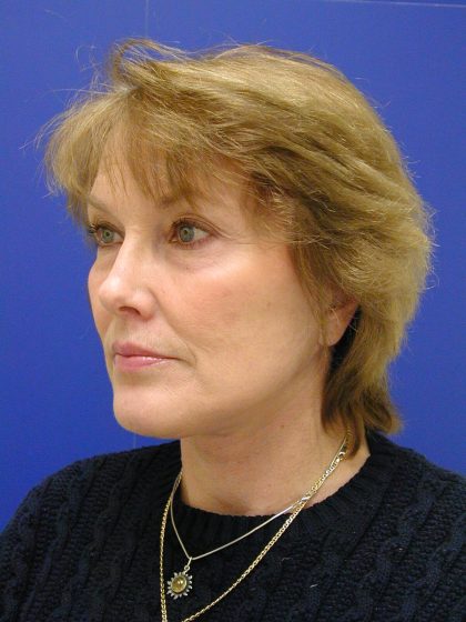 Face/Neck Lift Before & After Patient #549