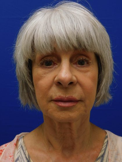 Face/Neck Lift Before & After Patient #524