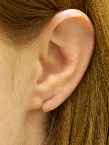 Earlobe Repair Before & After Patient #398