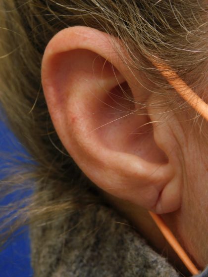 Earlobe Repair Before & After Patient #364
