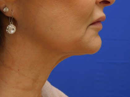 Face/Neck Lift Before & After Patient #492