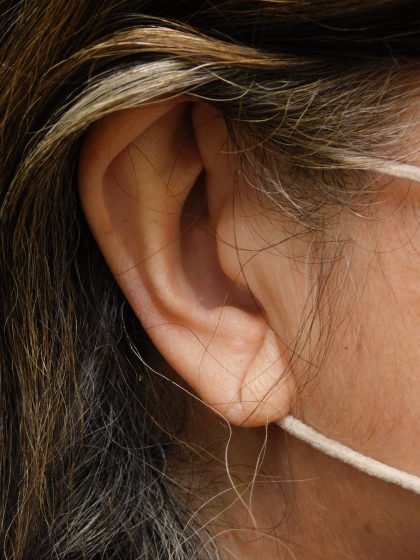 Earlobe Repair Before & After Patient #373