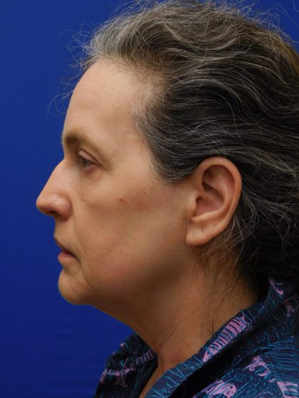 Face/Neck Lift Before & After Patient #513