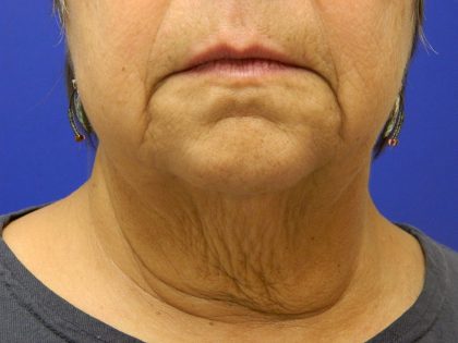 Face/Neck Lift Before & After Patient #558
