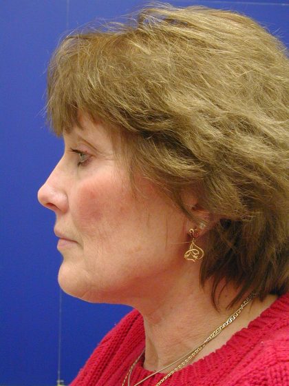 Face/Neck Lift Before & After Patient #549