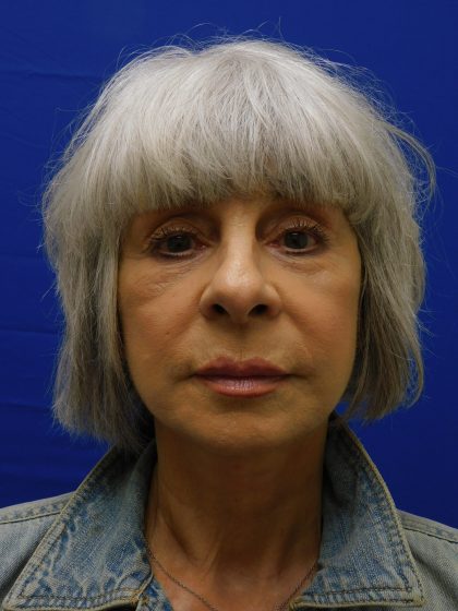 Face/Neck Lift Before & After Patient #524