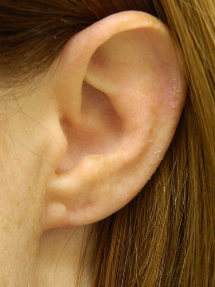 Earlobe Repair Before & After Patient #398