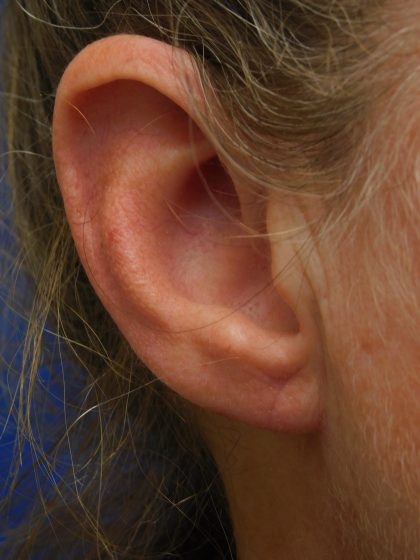 Earlobe Repair Before & After Patient #364