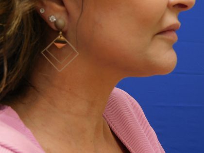 Face/Neck Lift Before & After Patient #492