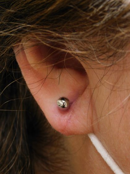 Earlobe Repair Before & After Patient #373