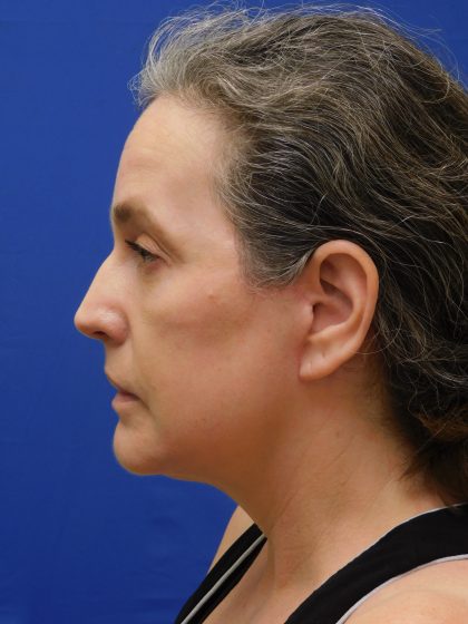 Face/Neck Lift Before & After Patient #513