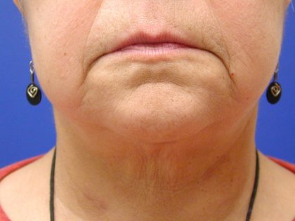 Face/Neck Lift Before & After Patient #558
