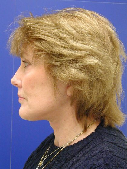 Face/Neck Lift Before & After Patient #549