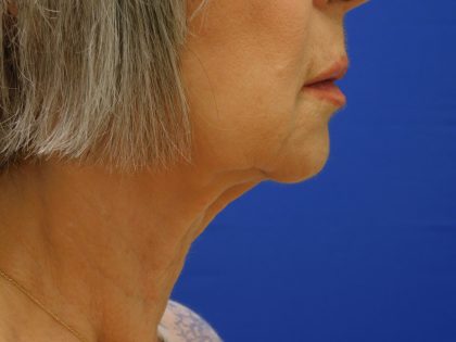 Face/Neck Lift Before & After Patient #524