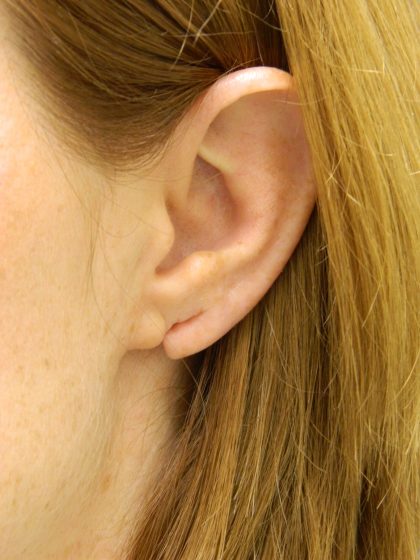 Earlobe Repair Before & After Patient #398