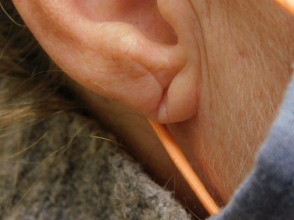 Earlobe Repair Before & After Patient #364