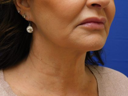 Face/Neck Lift Before & After Patient #492