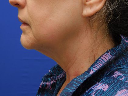 Face/Neck Lift Before & After Patient #513