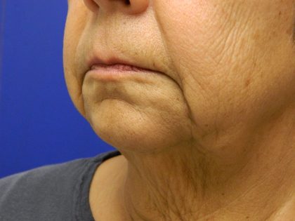 Face/Neck Lift Before & After Patient #558