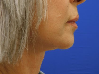 Face/Neck Lift Before & After Patient #524