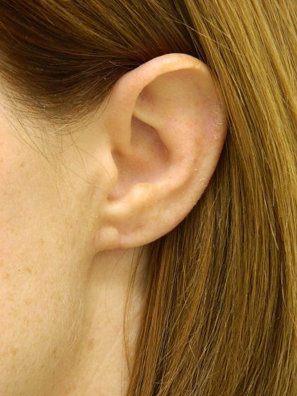 Earlobe Repair Before & After Patient #398