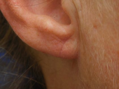 Earlobe Repair Before & After Patient #364