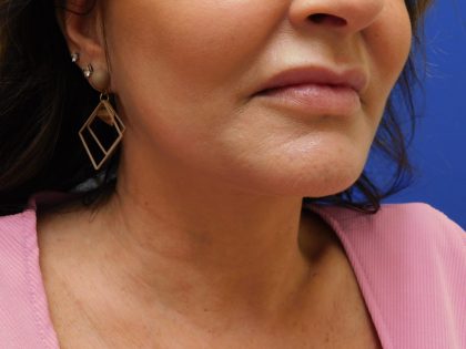 Face/Neck Lift Before & After Patient #492