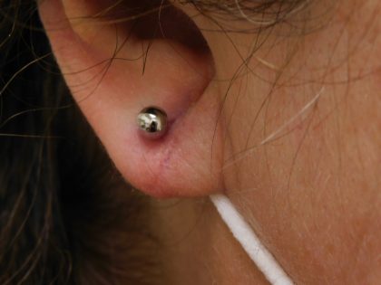 Earlobe Repair Before & After Patient #373