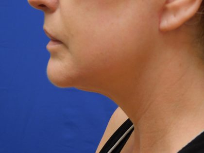 Face/Neck Lift Before & After Patient #513