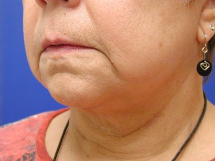 Face/Neck Lift Before & After Patient #558