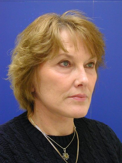 Face/Neck Lift Before & After Patient #549