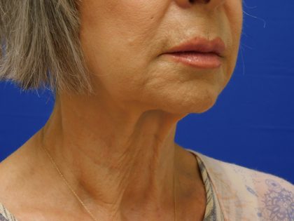 Face/Neck Lift Before & After Patient #524