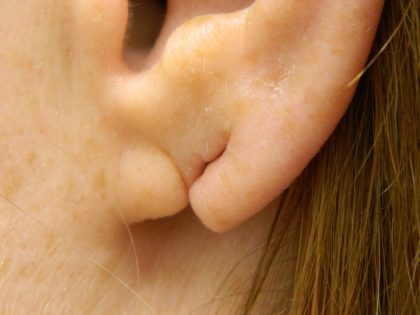 Earlobe Repair Before & After Patient #398