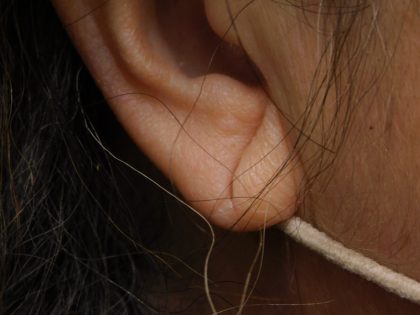 Earlobe Repair Before & After Patient #373