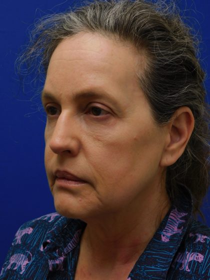 Face/Neck Lift Before & After Patient #513
