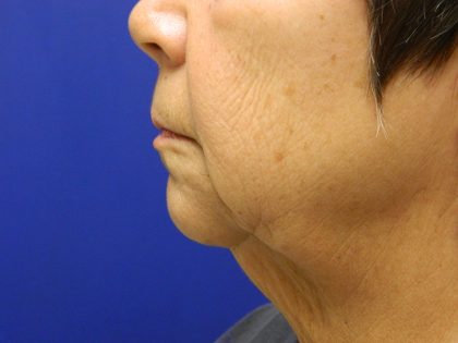 Face/Neck Lift Before & After Patient #558
